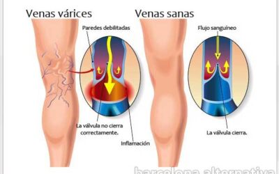 CONFLICTOS EMOCIONALES DE LAS VARICES