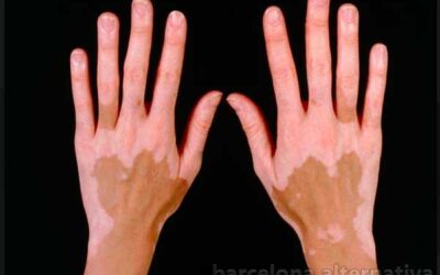 VITILIGO Y BIONEUROEMOCIÓN: MANCHA FAMILIAR, SEPARACIÓN BRUTAL